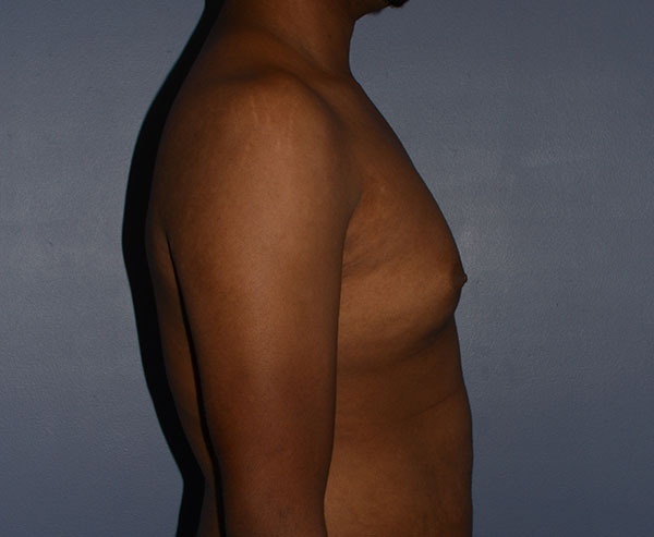 Male Breast Reduction