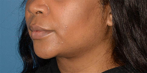 Buccal Fat Removal