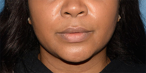 Buccal Fat Removal