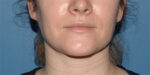 Chin and Jawline Liposuction