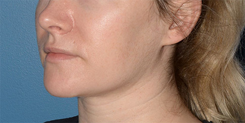 Chin and Jawline Liposuction