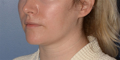 Chin and Jawline Liposuction