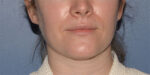 Chin and Jawline Liposuction