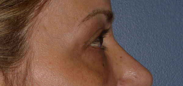 Eyelid Lift