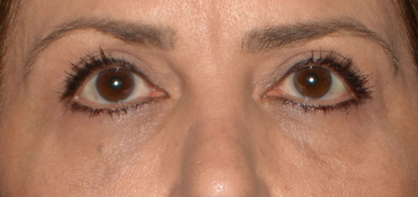 Eyelid Lift