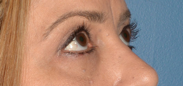 Eyelid Lift