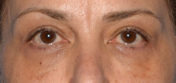 Eyelid Lift