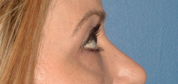 Eyelid Lift