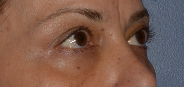 Eyelid Lift