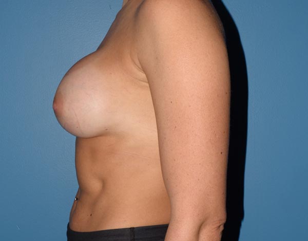 Breast Augmentation Implants