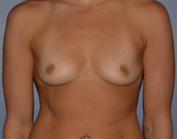 Breast Augmentation Implants