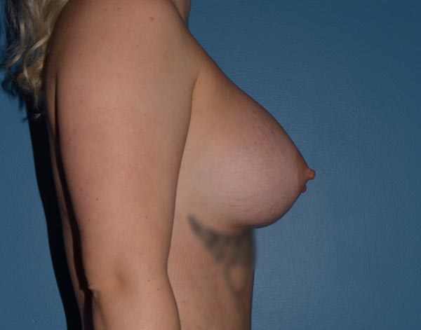 Breast Augmentation Implants