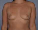 Breast Augmentation Implants