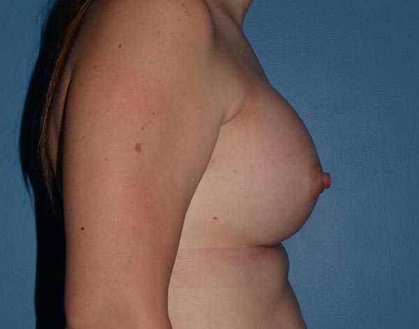 Breast Augmentation Implants