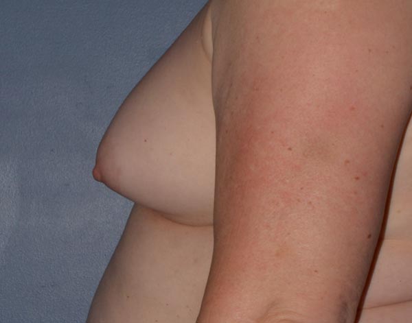 Breast Augmentation Implants