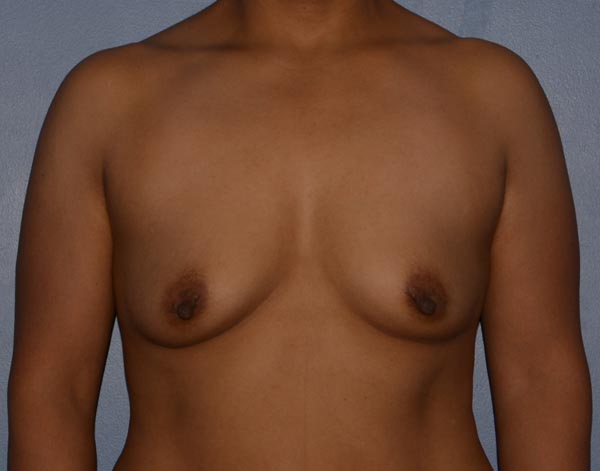 Breast Augmentation Implants