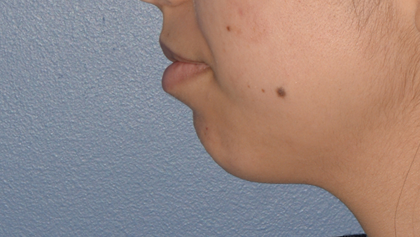 Chin Implant