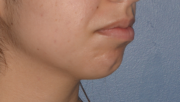 Chin Implant