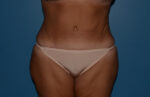 Tummy Tuck