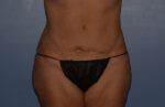 Tummy Tuck