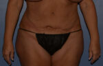 Tummy Tuck