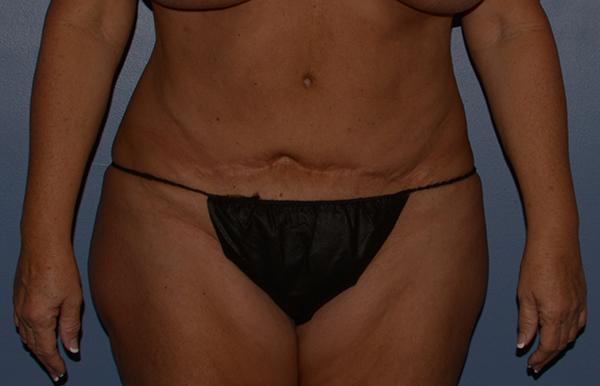 Tummy Tuck