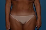 Tummy Tuck