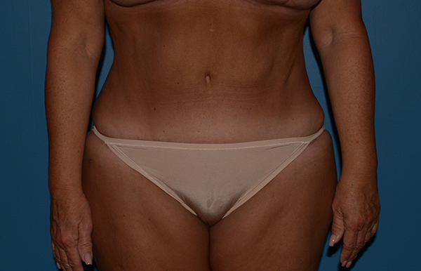 Tummy Tuck