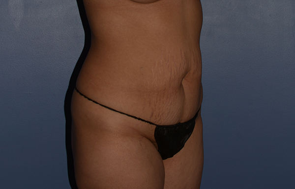 Tummy Tuck
