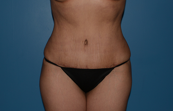 Tummy Tuck