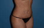 Tummy Tuck