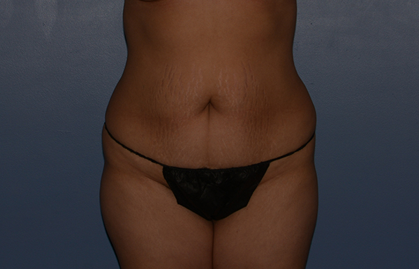 Tummy Tuck