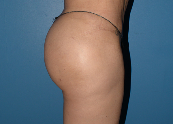 Brazilian Butt Lift
