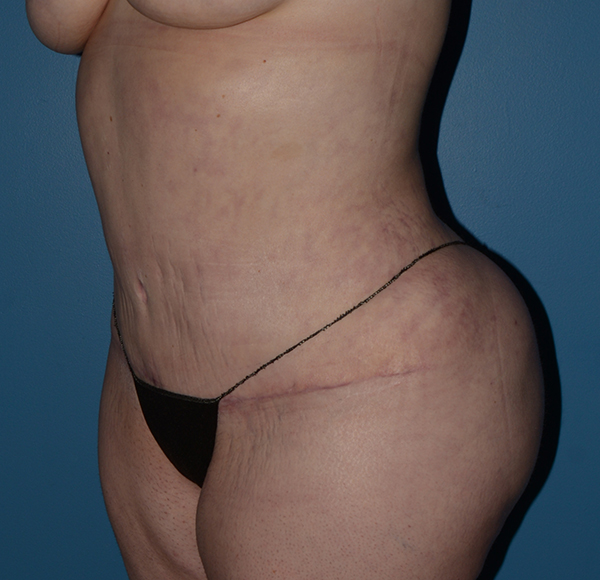 Tummy Tuck