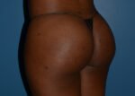 Brazilian Butt Lift