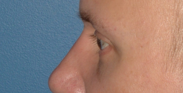 Eyelid Lift