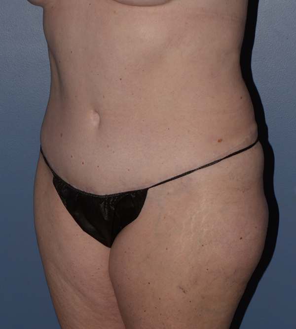 Liposuction