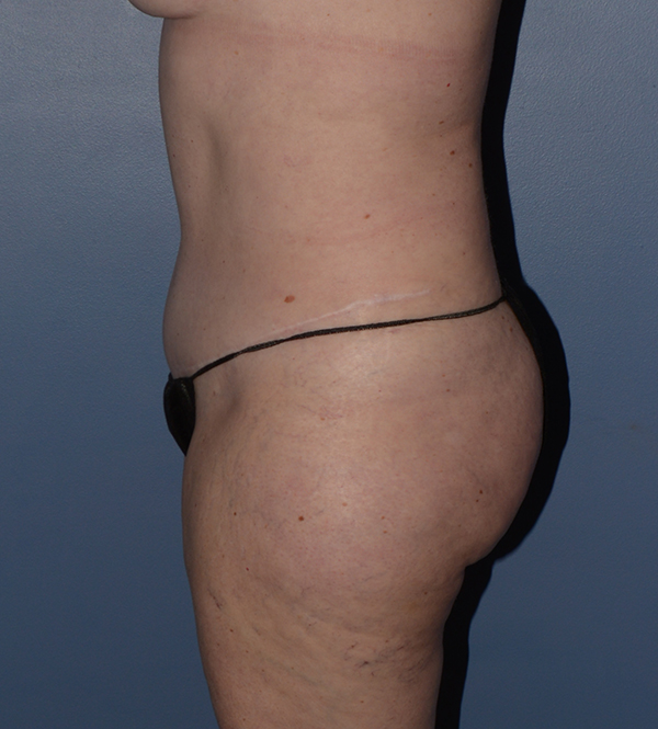 Liposuction