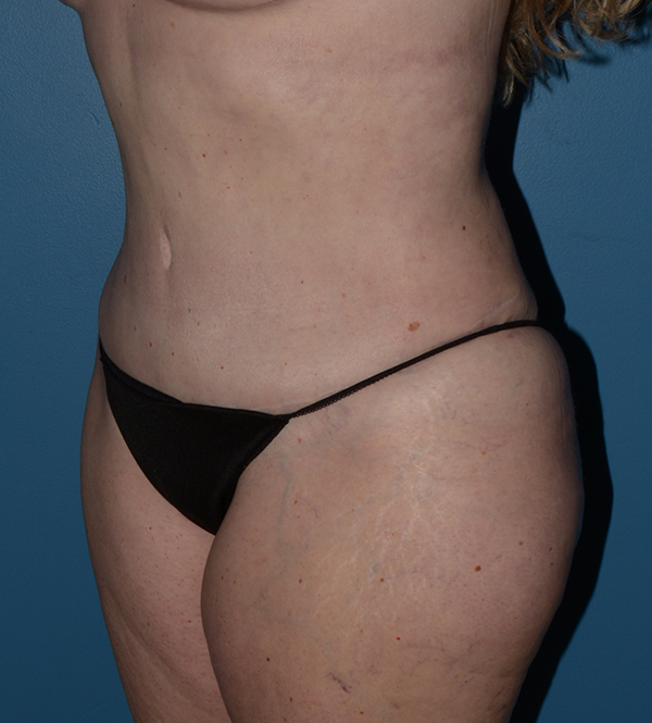 Liposuction