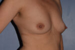 Breast Augmentation Implants