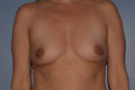 Breast Augmentation Implants