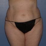 Tummy Tuck