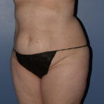 Tummy Tuck