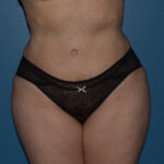 Tummy Tuck
