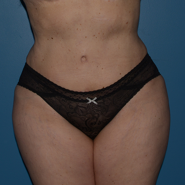 Tummy Tuck