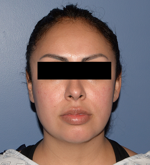 Buccal Fat Removal