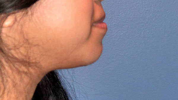 Chin Implant