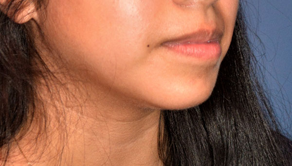 Chin Implant