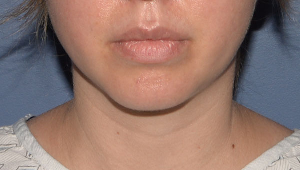 Chin Implant Surgery Results Bellevue WA