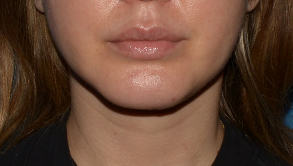 Chin Implant Surgery Results Bellevue WA